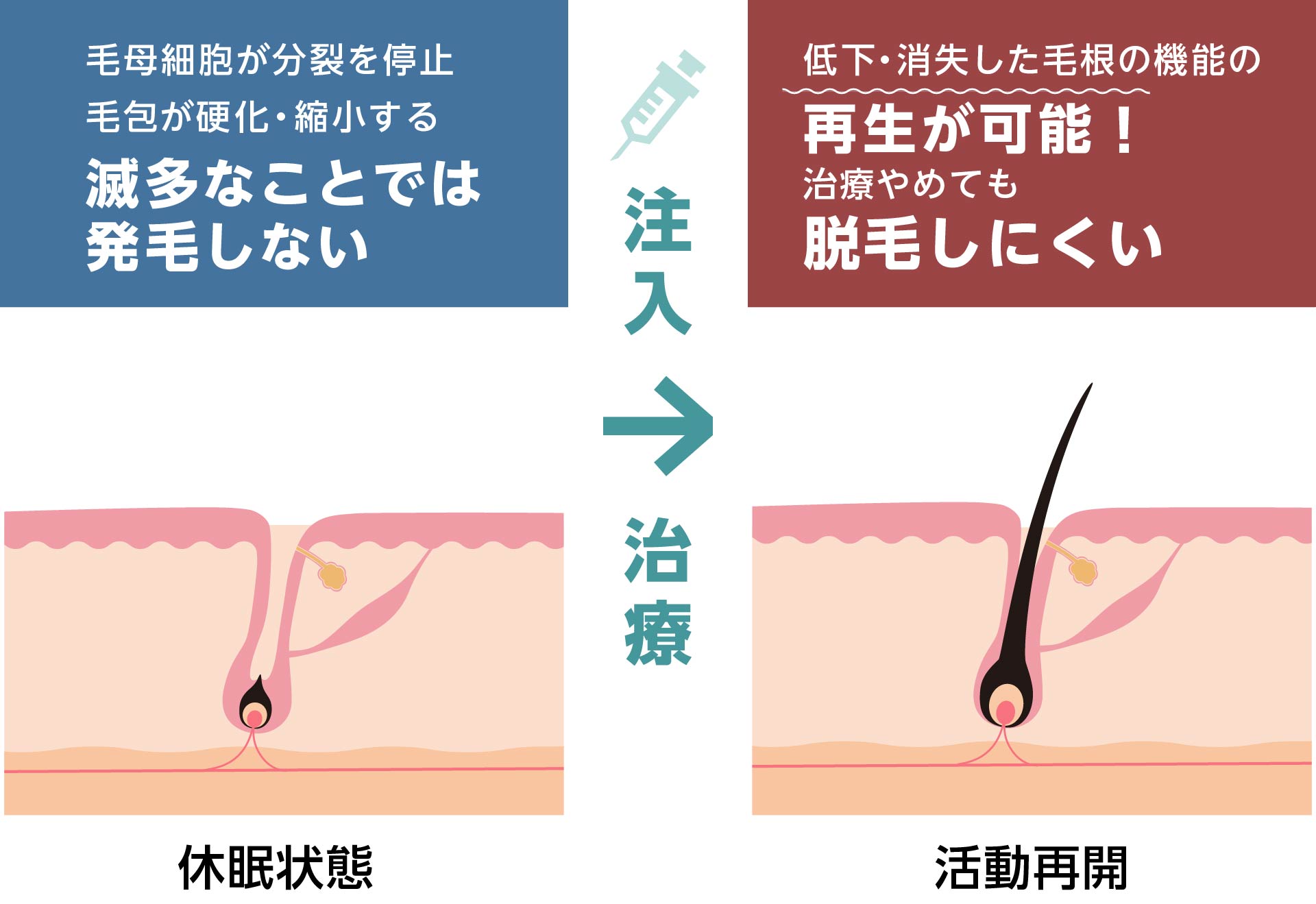 毛母細胞が分裂を停止
毛包が硬化・縮小する 滅多なことでは発毛しない 注入治療後　低下・消失した毛根の機能の
再生が可能！治療やめても元に戻らない