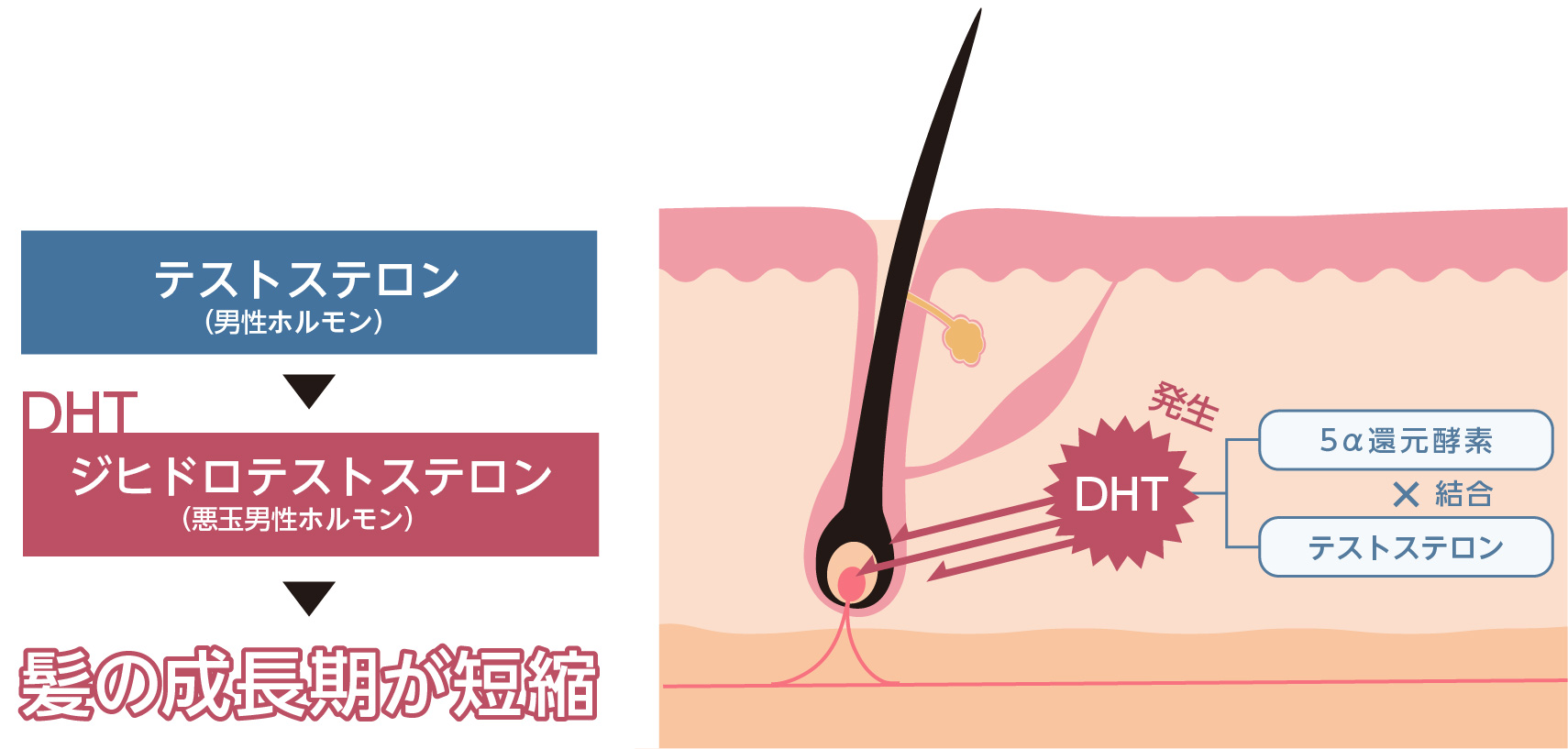 テストステロン（男性ホルモン）が５α還元酵素と結合してDHT（ジヒドロテストステロン）に変化。毛根を攻撃して髪の成長期が短縮される。