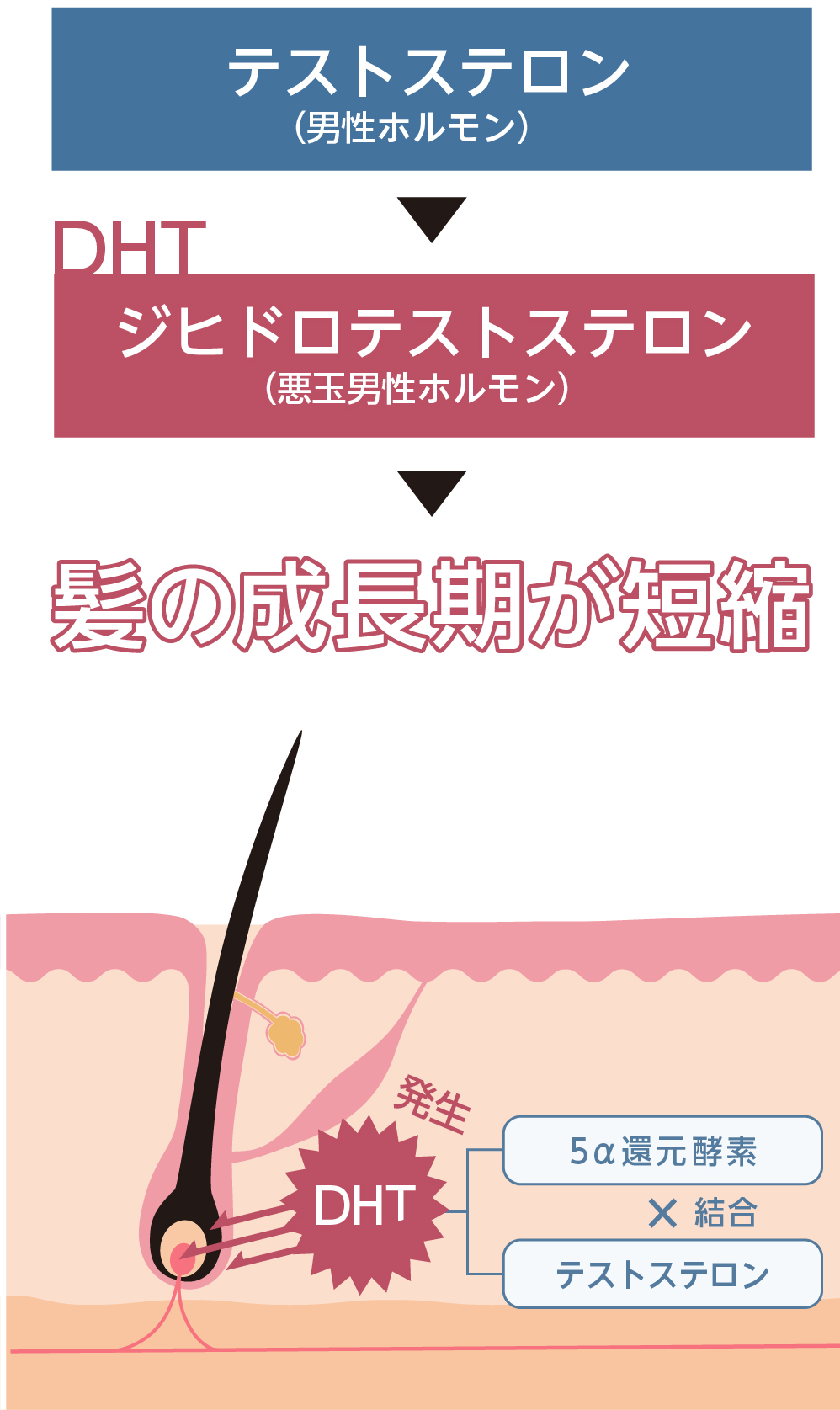 テストステロン（男性ホルモン）が５α還元酵素と結合してDHT（ジヒドロテストステロン）に変化。毛根を攻撃して髪の成長期が短縮される。