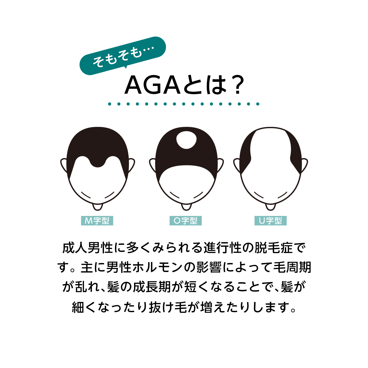 そもそも…AGAとは？AGAとは「男性型脱毛症（Androgenetic Alopecia）」の略で、成人男性に多くみられる進行性の脱毛症です。主に男性ホルモンの影響によってヘアサイクル（毛周期）が乱れ、髪の成長期が短くなることで、髪が細くなったり抜け毛が増えたりします。生え際の後退や頭頂部の薄毛などが特徴で、何も対策をしない場合、徐々に進行していく傾向があります。
そのため、気になる症状がある場合は早めに相談・対策を始めることが大切とされています。