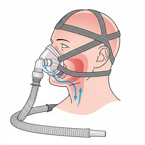 CPAP